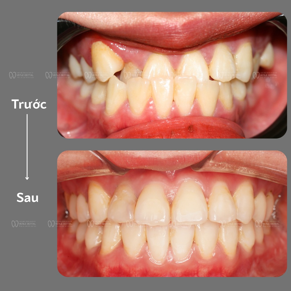 Feedback khách chỉnh nha yenle dental